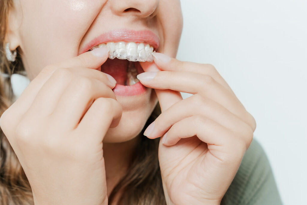 Close-up of woman inserting transparent dental aligner onto upper teeth using both hands, teeth straightening, orthodontics